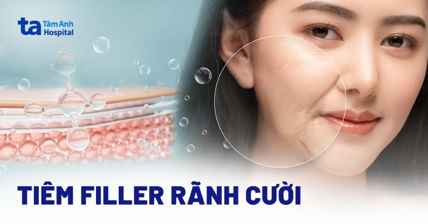 tiêm filler rãnh cười