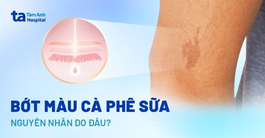 bớt màu cà phê sữa