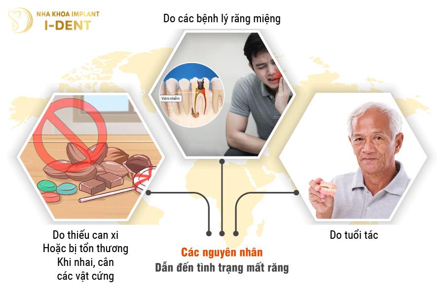 Các nguyên nhân dẫn đến tình trạng mất răng